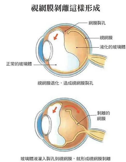 眼前有黑点飞蚊症,眼前有飞蚊症是怎么回事