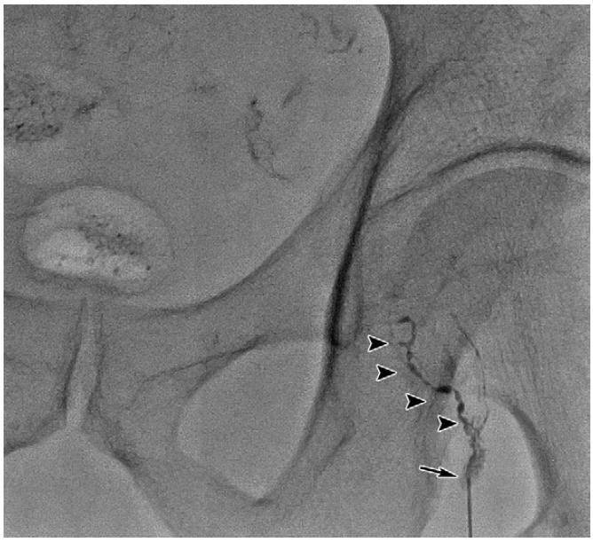 盆腔囊肿复发,盆腔淋巴管囊肿