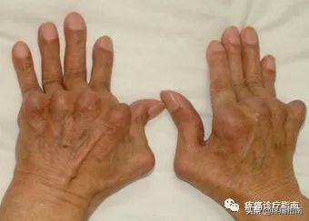 骨性关节炎诊疗指南,骨性关节炎诊疗指南欧美