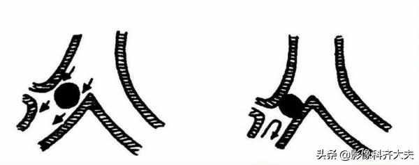 孩子支气管异物ct能查出吗,儿童支气管异物诊断方法