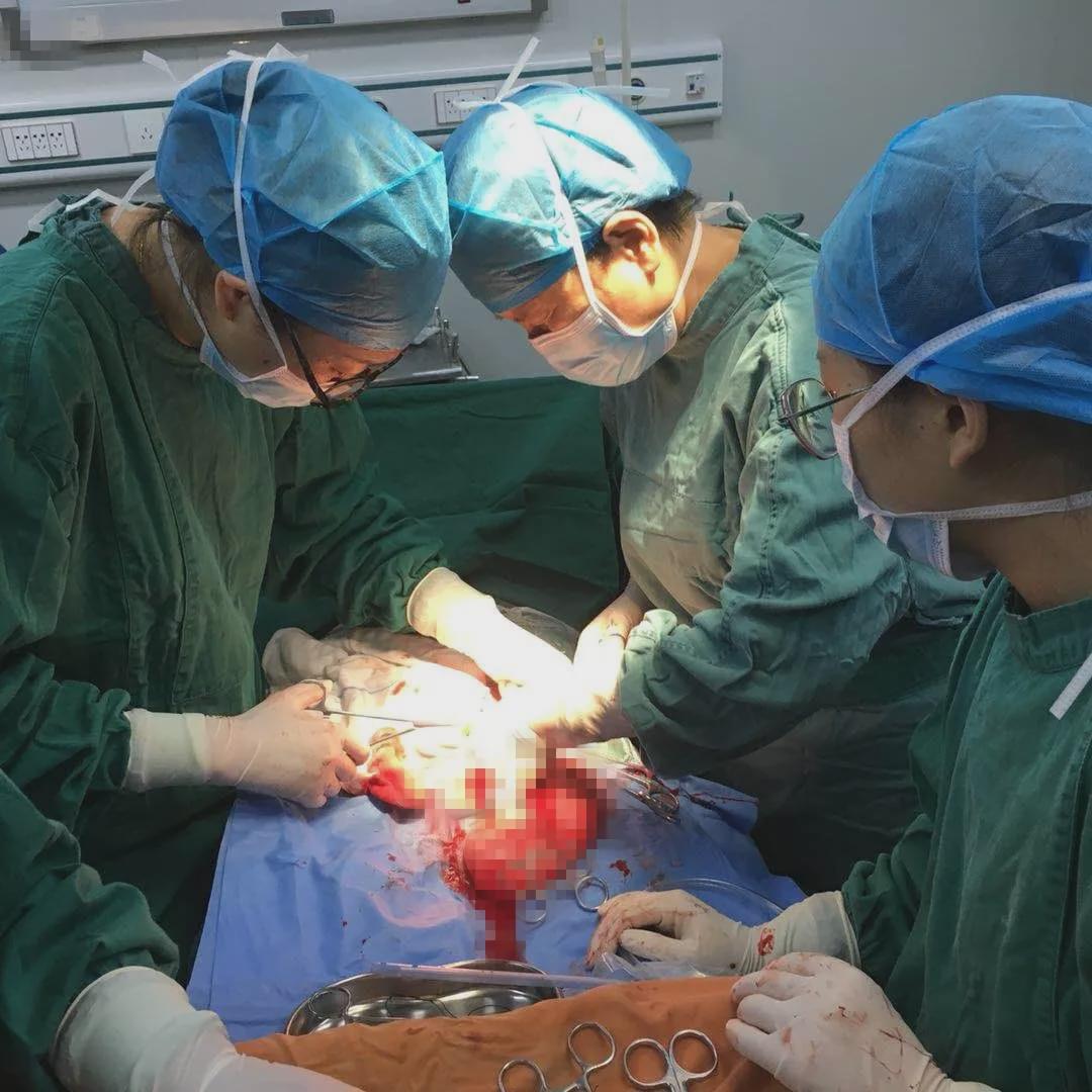 剖腹产把卵巢囊肿切除能喂母乳吗,剖宫产加卵巢囊肿手术时间多久