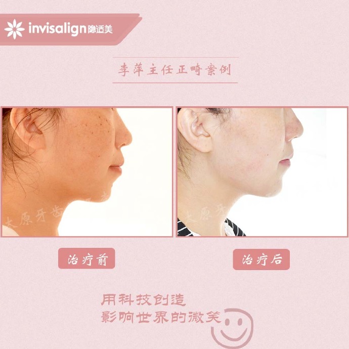 太原牙齿矫正拔牙拔六颗有危害吗,太原牙齿开合矫正