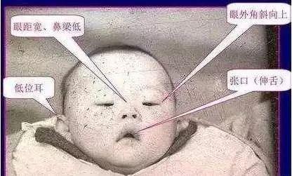 七种孕妇容易出唐氏儿,40岁孕妇唐氏筛查出高风险