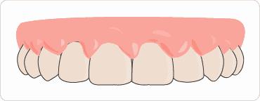 龅牙拥挤矫正需要拔牙吗,牙齿拥挤要拔智齿吗