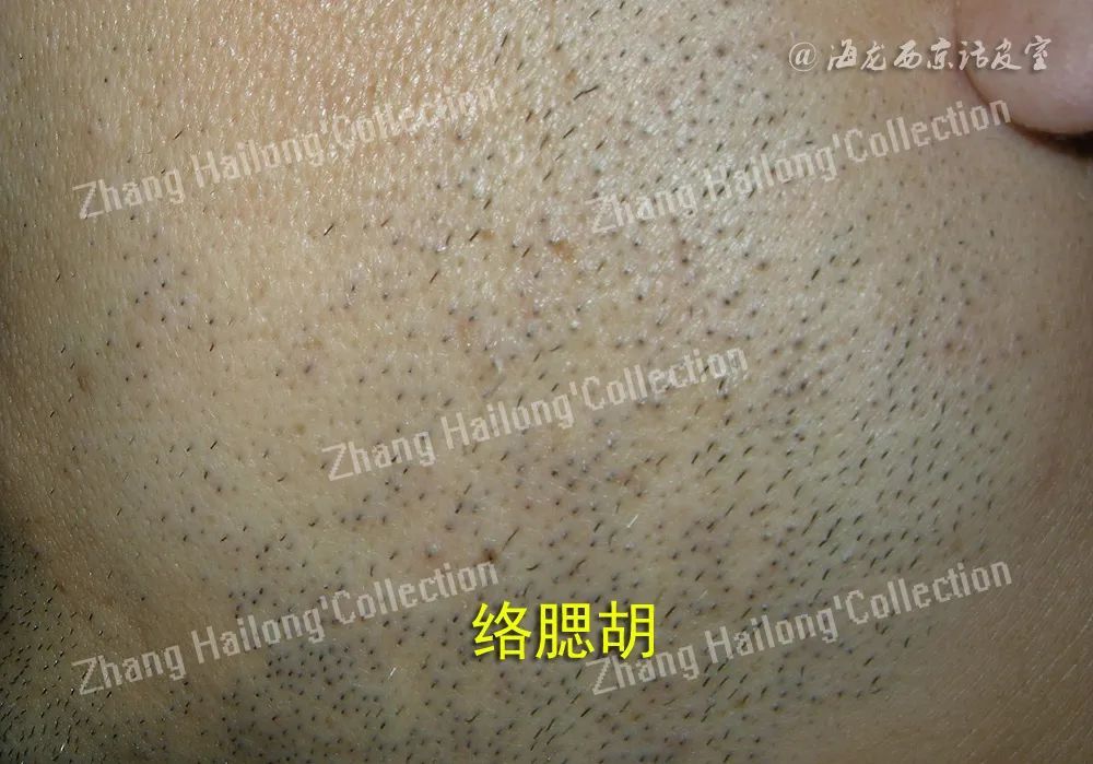 猕猴桃女孩冰点脱毛频率,激光脱毛猕猴桃女孩必备