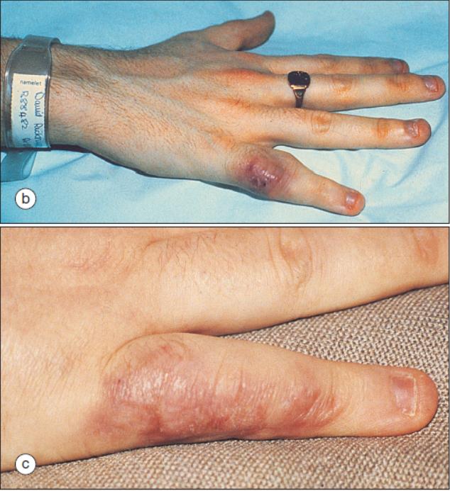 结节病关节痛眼睛模糊,结节病引起的关节炎