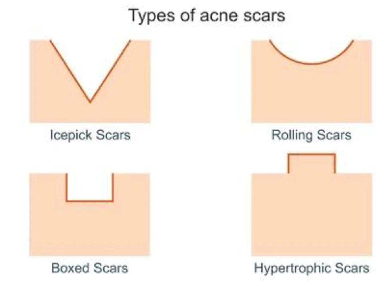 长疱疹的伤疤怎么治,长疮的疤痕怎么消除