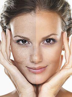 吉米祛斑怎么使用视频,吉米的祛斑产品真的可以祛斑吗