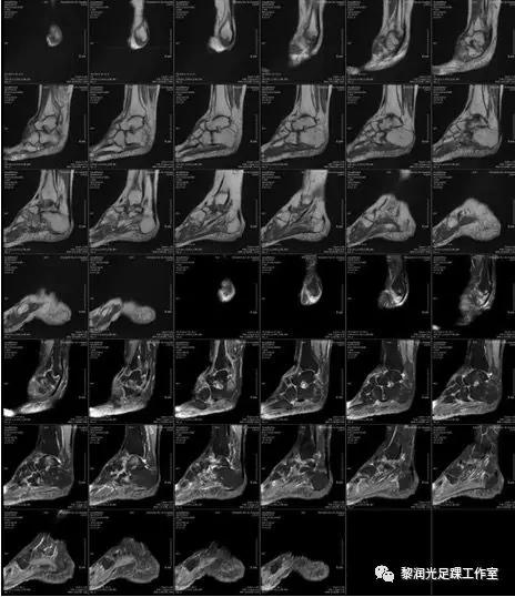 伊里扎洛夫外固定架治疗足部畸形,足部畸形矫正的技巧