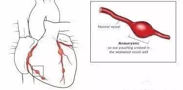 孩子扁桃体发炎连续三天高烧不退,老人连续几天高烧不退怀疑什么病