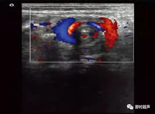 小儿消化道急症超声