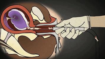 在中国，每天有36000个女孩被骗堕胎