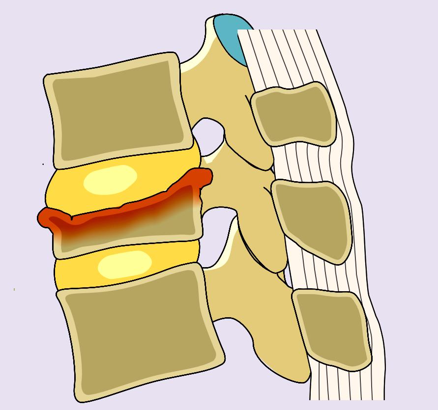 骨质疏松椎体压缩性骨折治疗指南,德国骨科骨质疏松骨折
