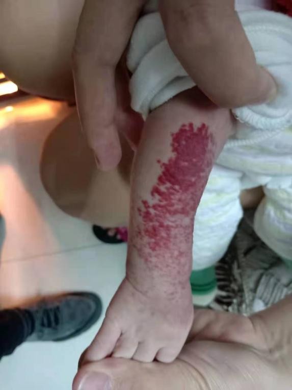 郴州市第一人民医院祛胎记,郴州第一人民医院治疗肝脏血管瘤