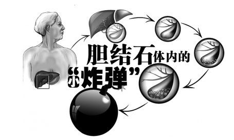 胆源性胰腺炎胆囊切除后饮食注意,胆囊切除胆总管增宽要注意饮食吗