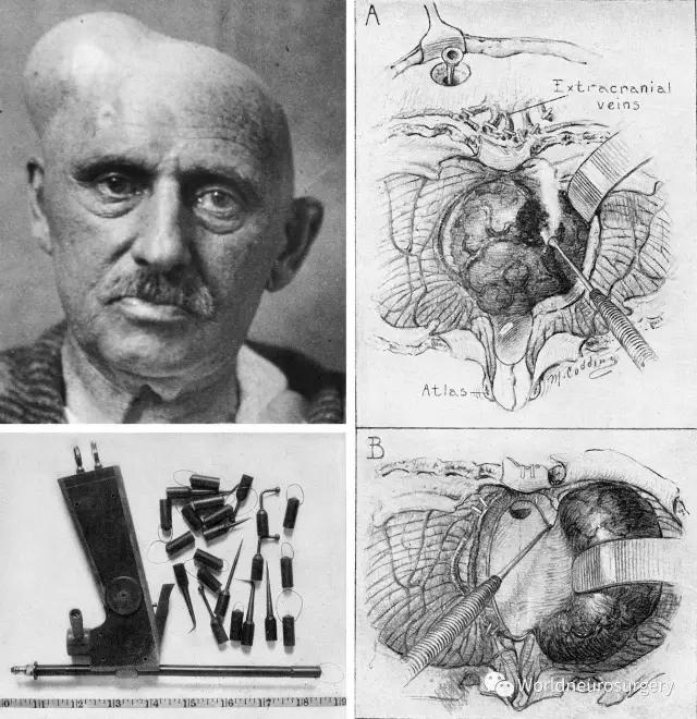 神外外科护理创新,神外介入手术入门