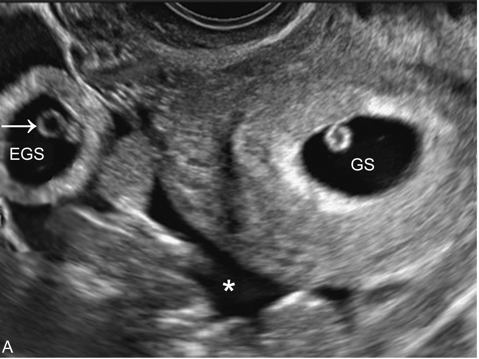 输卵管妊娠的典型超声表现为,输卵管妊娠的超声表现