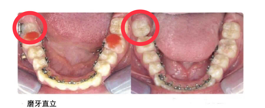 矫正牙齿在牙龈打钉子多久能取,整牙一定要在牙龈里打钉子吗