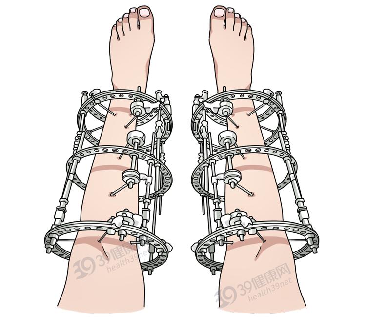 做断骨增高的人怎么样了,做了断骨增高看得出来吗
