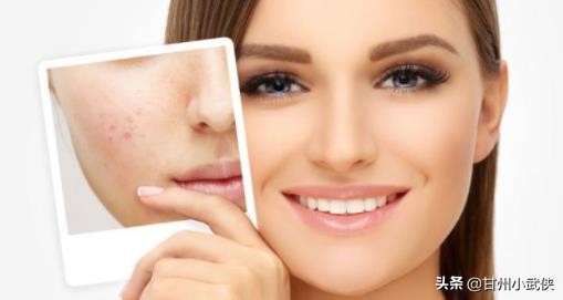 五十岁脸上长痘痘鼻子也长痘,脸上长痘痘身上长痘的原因