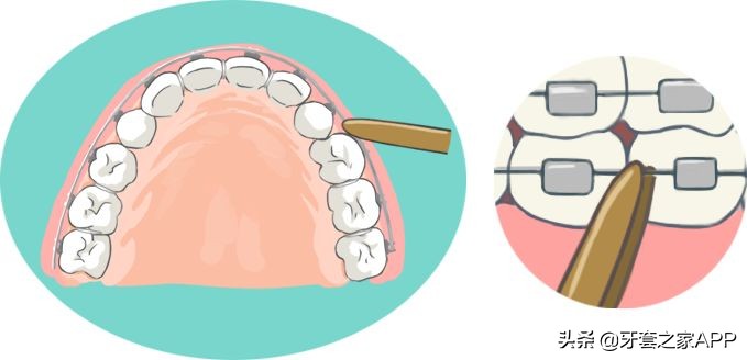 疫情复诊牙套能用吗现在,疫情期间牙齿出现问题怎么办