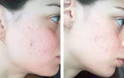 用了成百上千张化妆棉，皮肤却越来越薄了，原来是打开方式不正确