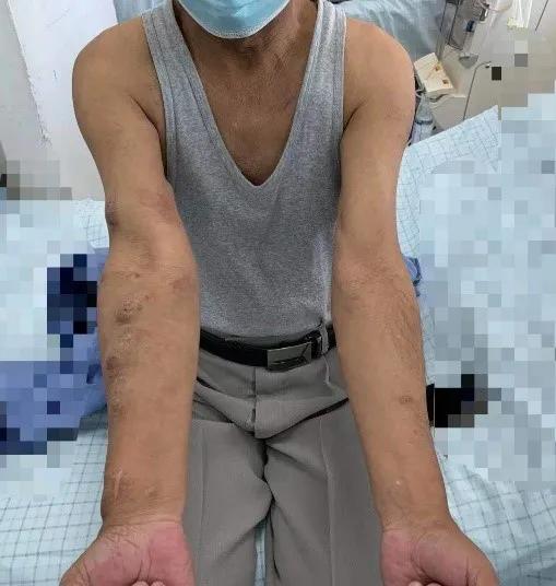 dsa食管狭窄球囊扩张术,经皮静脉超声引导下球囊扩张术