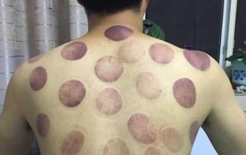 拔罐的黑印真的是体内毒素吗？拔罐师傅给出解释，看完长见识了！