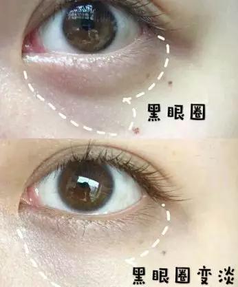 去眼纹去黑眼圈用什么方法,去眼袋眼纹公认最好用的土方法