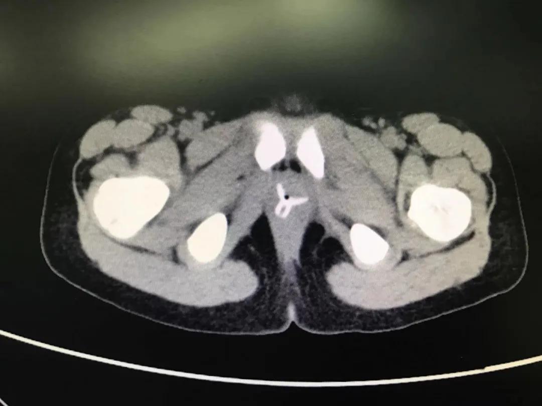 四岁小男孩往小丁丁里塞弹珠？那些年孩子塞进去的东西远不止这个
