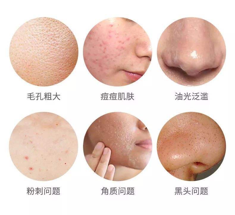 黑头越拔越多，一定是你用了错误的方法，这三个方法才最有效