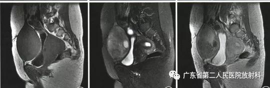这个病例让我大涨知识：14岁男性右小腿痛性包块