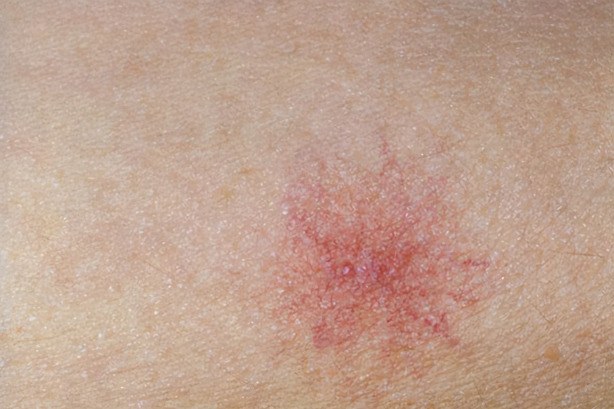 每年体检肝都没问题面部长蜘蛛痣,脸上出现蜘蛛痣就代表肝有毛病吗