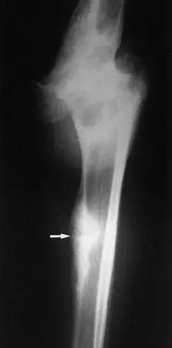 神经性骨关节病,神经性关节炎症状图片