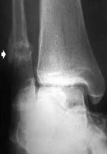 神经性骨关节病,神经性关节炎症状图片