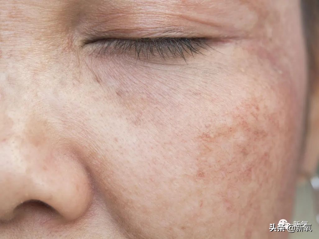 宋祖儿雀斑造型美到窒息,宋祖儿脸上的雀斑一清二楚