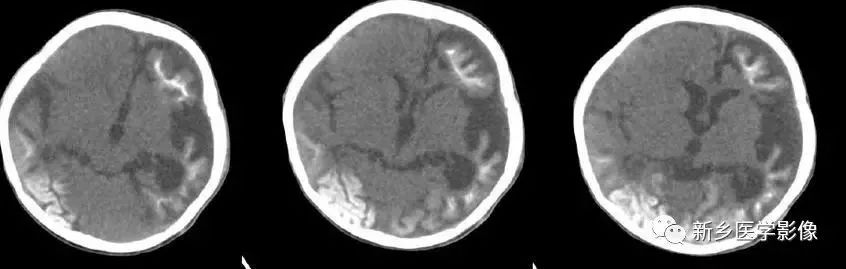 什么引起成人脑室扩大,哪些病可以导致左侧脑室增宽