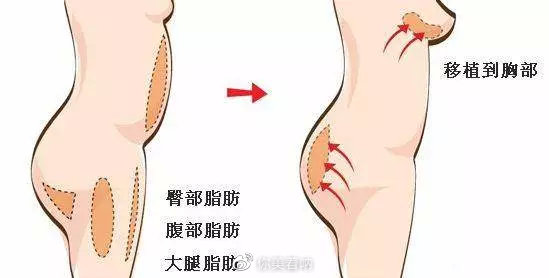 隆胸选择光面还是毛面,隆胸选高凸还是中凸