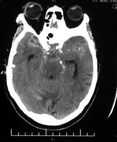 卢旺盛：脉瘤和基底动脉动脉瘤裸栓治疗术后效果非常明显
