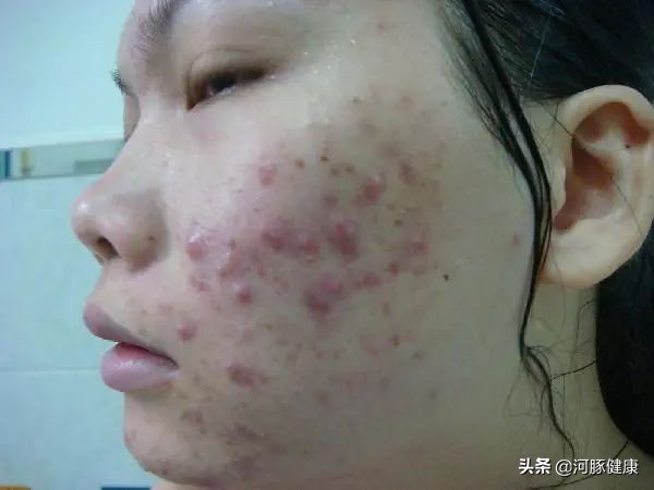 被*疮痤**遮盖了颜值？来聊聊*疮痤**的常用药物吧？