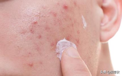 有什么适合祛痘印的药膏,有没有什么祛痘印特别好用的产品