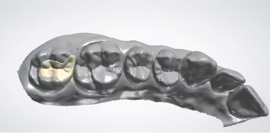 椅子修复工艺视频,椅旁修复技术安全性