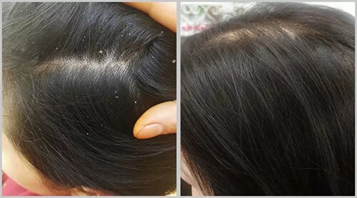 解决头发干燥和头屑的洗发水,染头发后一直掉头屑怎么解决