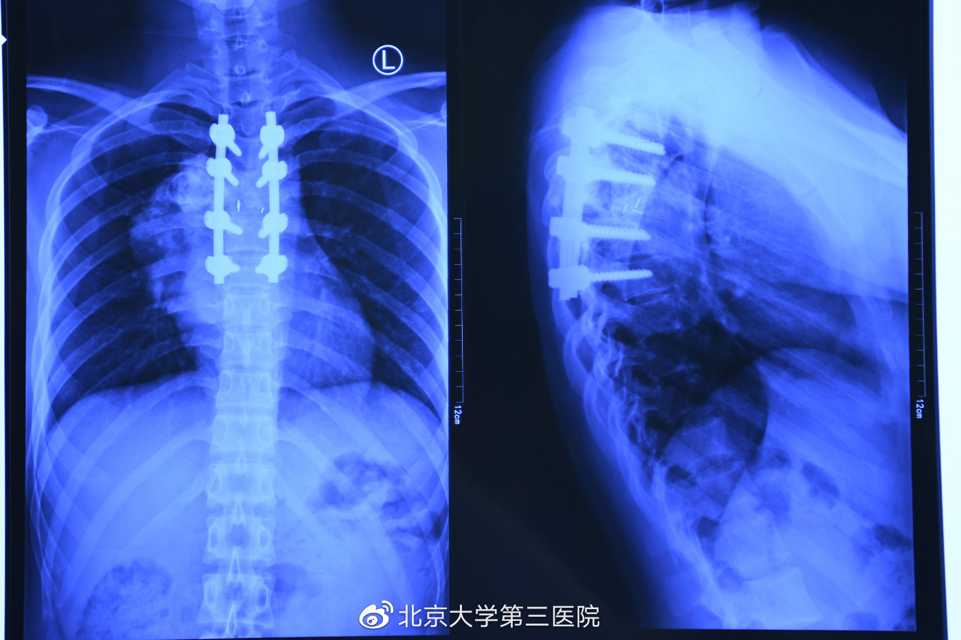 北医三院就医最新消息,北医三院新消息
