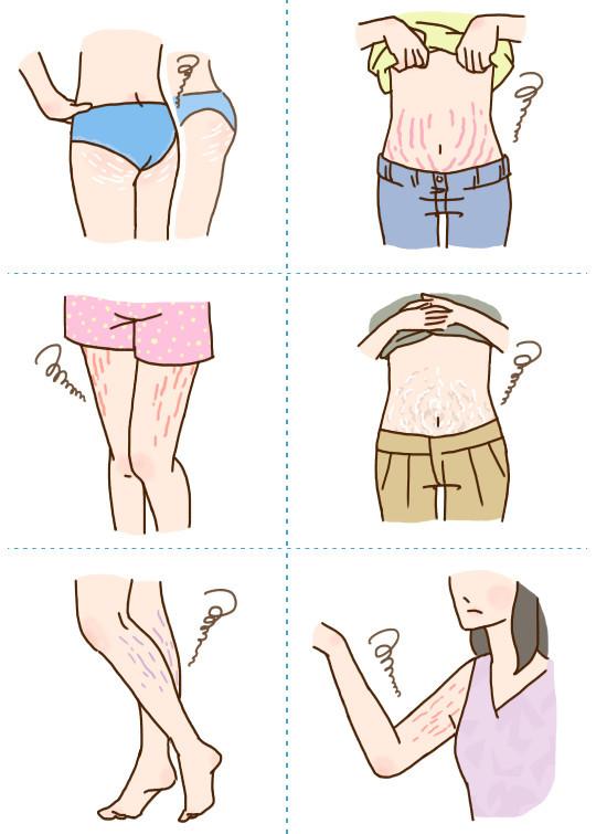 青少年会长妊娠纹吗,青少年膝盖有妊娠纹怎么回事