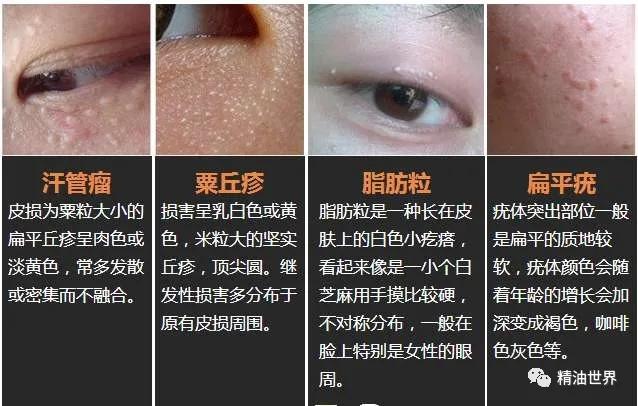 怎么会长脂肪粒啊,脸为啥会长脂肪粒