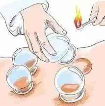 腰三横突综合征疼痛缓解方法,第三腰突综合症腰疼怎么治疗