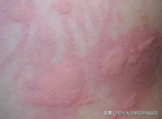 风疙瘩解决办法,风疙瘩的症状和图片