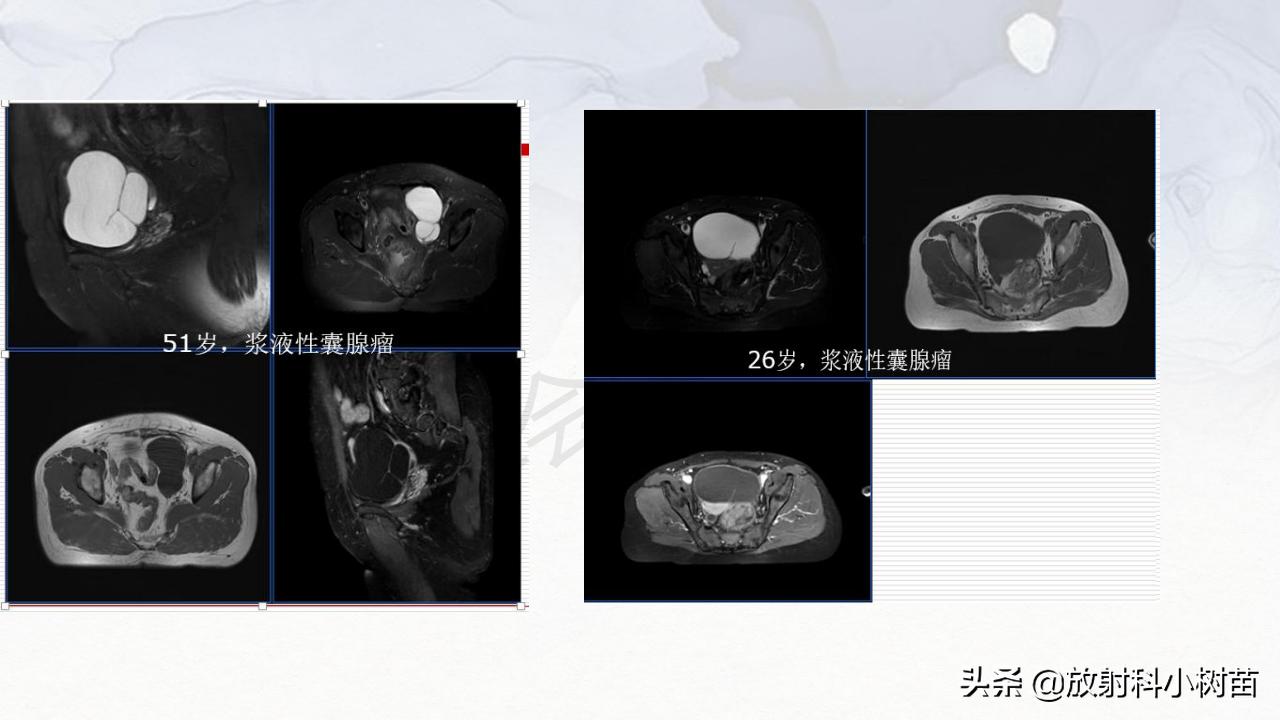 女性盆腔mri解剖图谱,泌尿生殖系统x线解剖