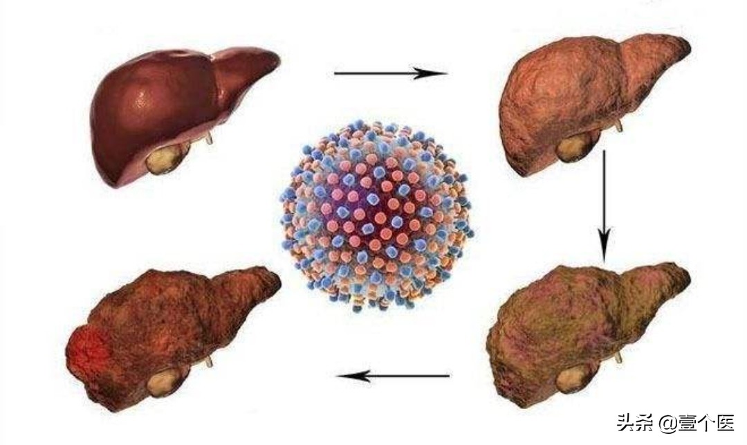癌前病变非典型增生解释,病理出现原位癌和浸润性癌